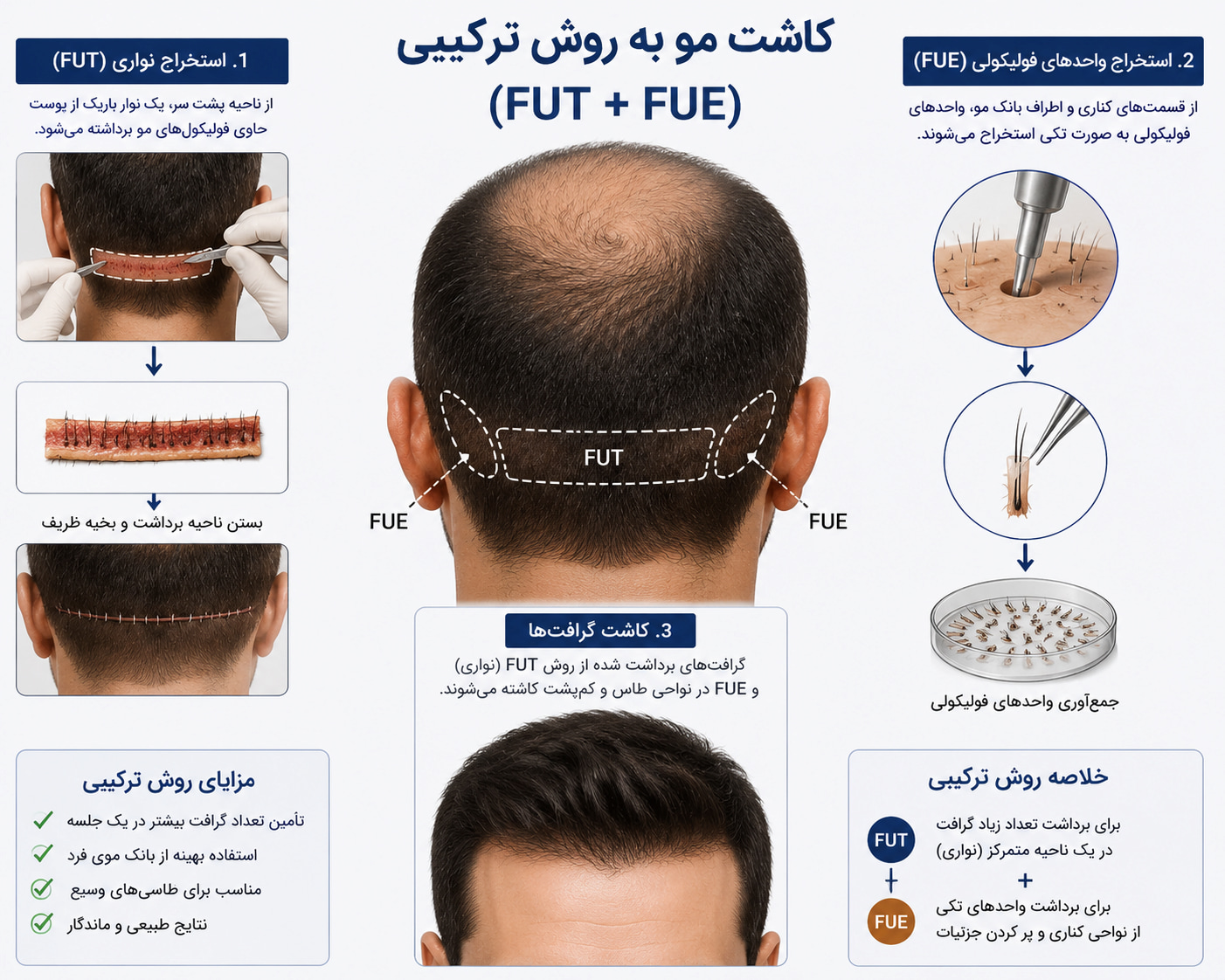 کاشت مو به روش ترکیبی FUT و FUE