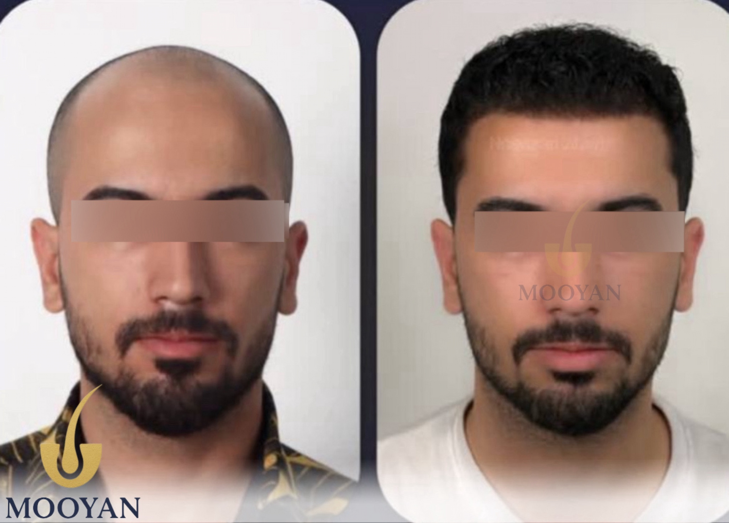 نتیجه طبیعی کاشت مو پس از رشد کامل