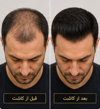 مقایسه نتیجه قبل و بعد از کاشت مو با تراکم طبیعی و خط رویش مناسب