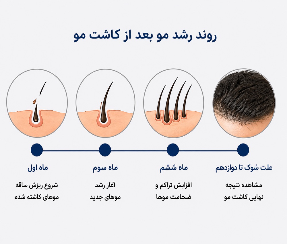 اینفوگرافی روند رشد مو بعد از کاشت و زمان شروع شوک ریزش تا مشاهده نتیجه نهایی