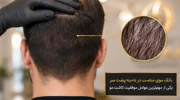 کاشت مو به روش Micro SUT