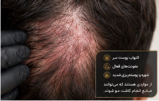 بیماری‌های پوست سر که ممکن است مانع انجام کاشت مو شوند